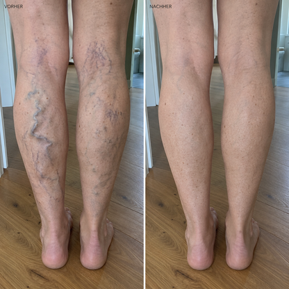 Vorher-Nachher Wunderbalsam: Waden von hinten einer Frau Ende 50, links mit mehreren Krampfadern, rechts glätte Haut
