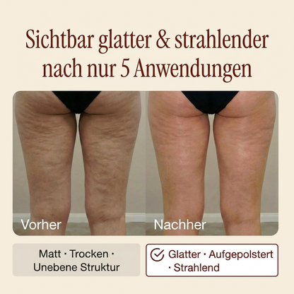 Vorher-Nachher: sichtbar glattere Oberschenkel nach 5 Anwendungen